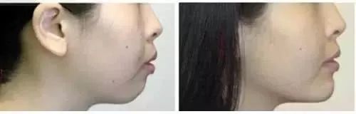 下巴后缩嘴凸整牙,怎么判断是牙凸还是下巴后缩