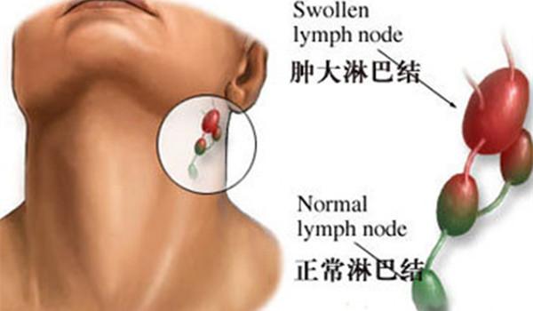 淋巴肿大脓没排干净怎么处理,淋巴疏通排毒究竟是何方骗术