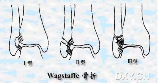 所有骨折都叫什么名字,骨折的名称有哪些