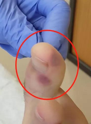 新冠引起疖肿,新冠病毒会引起皮肤长痘吗