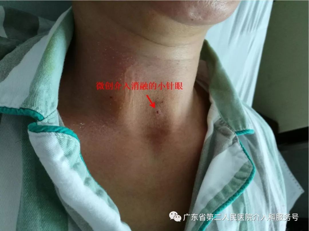 甲状腺结节观察与药物治疗2年能否缩小？微创消融治疗3年后如何？