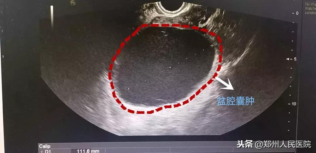 女子持续高烧不明原因,女子高烧不退最新新闻