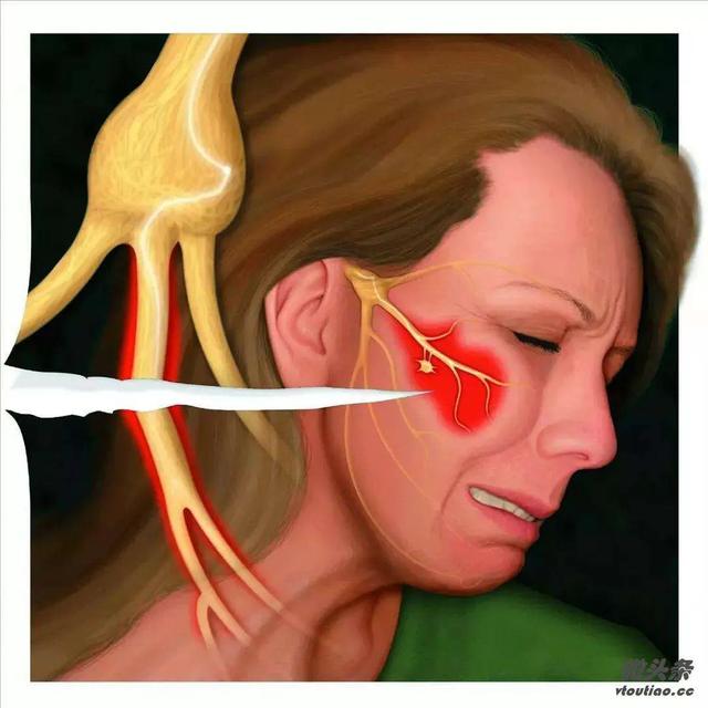 太阳穴和牙疼是不是三叉神经痛,牙疼下巴疼脸也疼是三叉神经疼吗