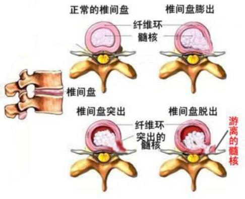 膨出型突出型脱出型游离型分类,腰椎间盘膨出和腰间盘突出的区别