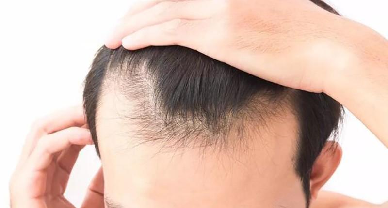 想要头发浓密植发,想要头发茂盛