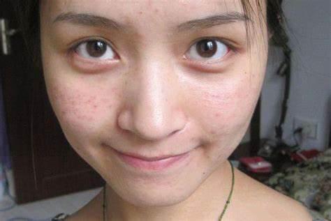 夏天怎么祛痘最有效,夏天长痘痘用什么护肤品