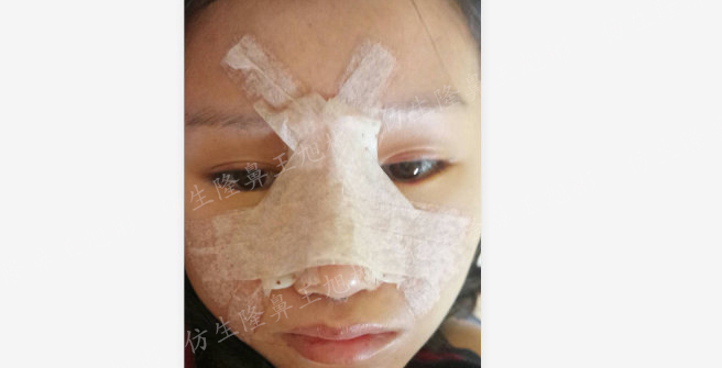 山根低鼻头大隆鼻,鼻根很低的隆鼻后的效果