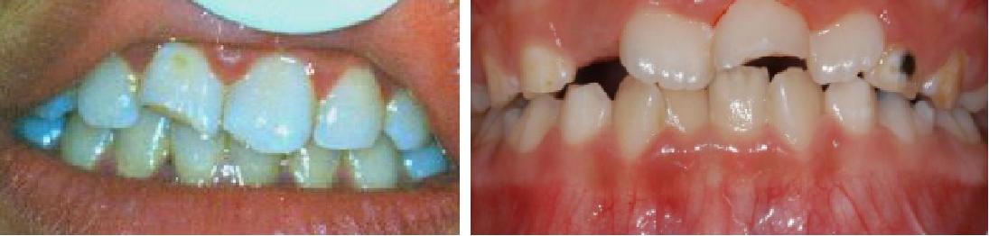 儿童牙外伤的分类及处理方法,儿童牙齿外伤需要检查哪些项目