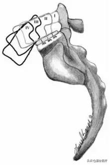 腰椎椎弓崩裂是什么原因造成的,腰痛是犯了什么因果