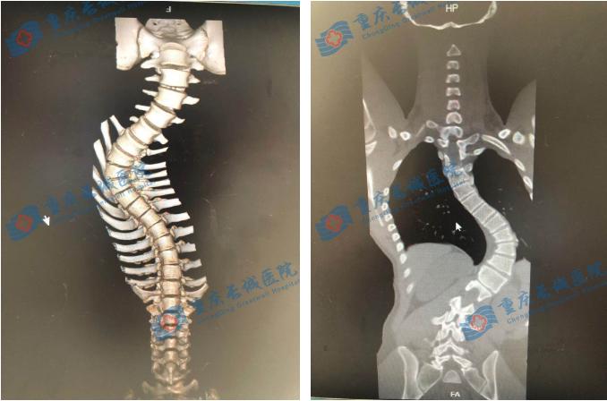 关爱脊柱健康儿童脊柱侧弯,关注脊柱侧弯让孩子少走弯路