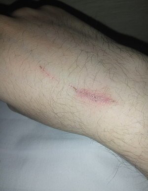 出很多血的伤口会感染破伤风吗,如果感染了破伤风伤口是什么情况