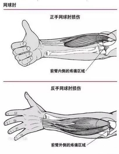 网球肘肌肉劳损,网球肘造成胳膊弯了最佳治疗方法