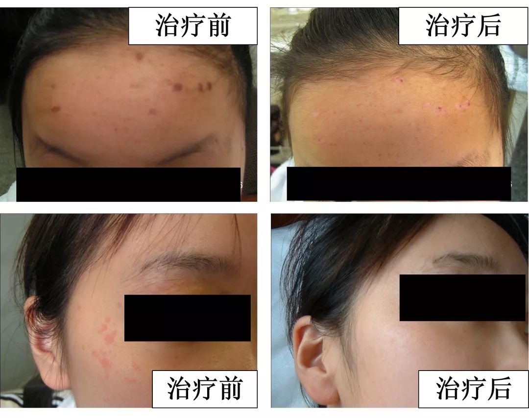 中医火针疗法教学视频,火针操作手法