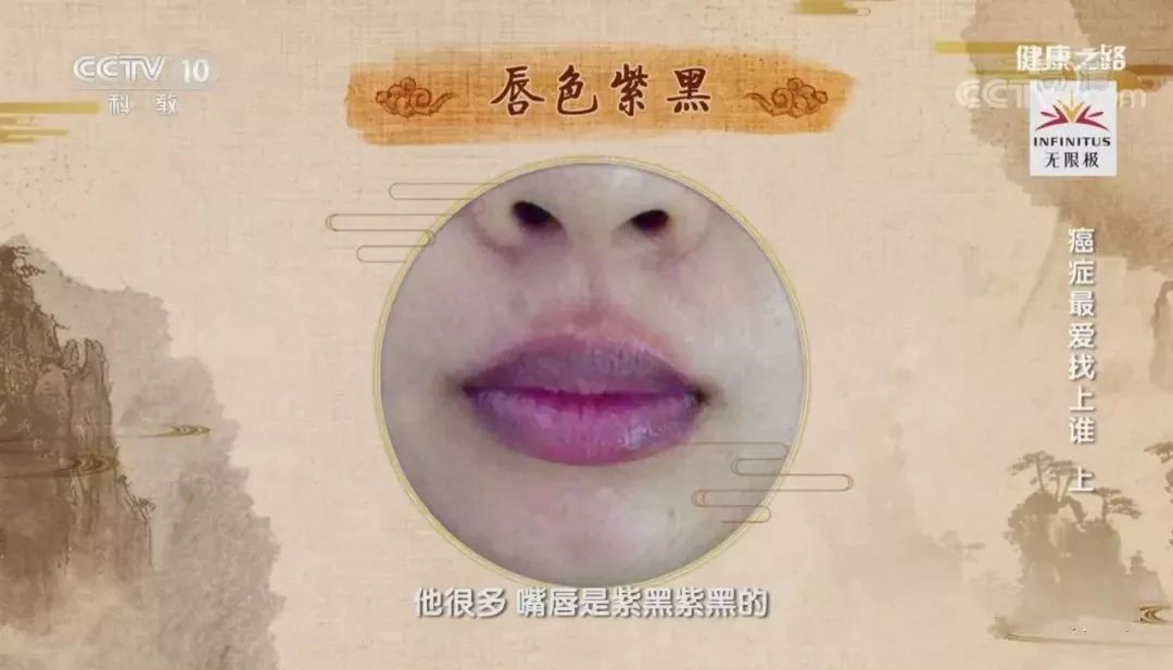 23岁女子患外阴癌癌前病变,23岁外阴癌变化