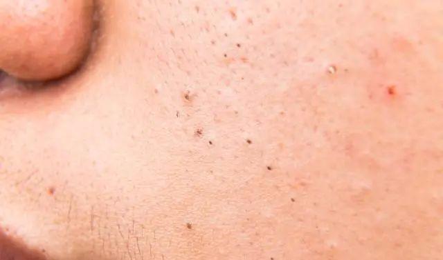 去黑头毛孔粗大最有效的医美方法,医美去黑头缩毛孔方法