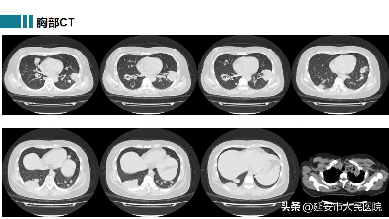 治疗肉芽肿性血管炎哪家医院好,嗜酸性肉芽肿性血管炎哪家医院好