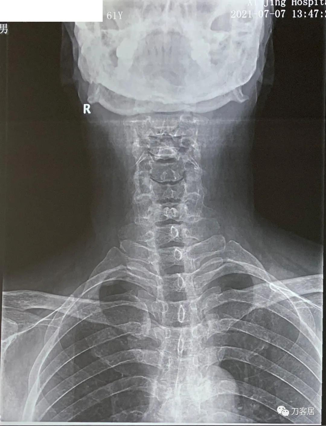 病例左侧躯体麻木,右侧肢体麻木典型病例