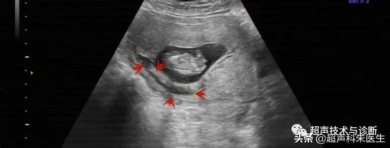 绒毛膜下血肿的超声图像,绒毛膜下血肿一般有啥症状