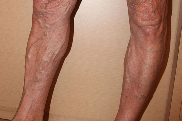 静脉曲张是什么？什么人群容易发作？如何减少腿上的“小蚯蚓”？