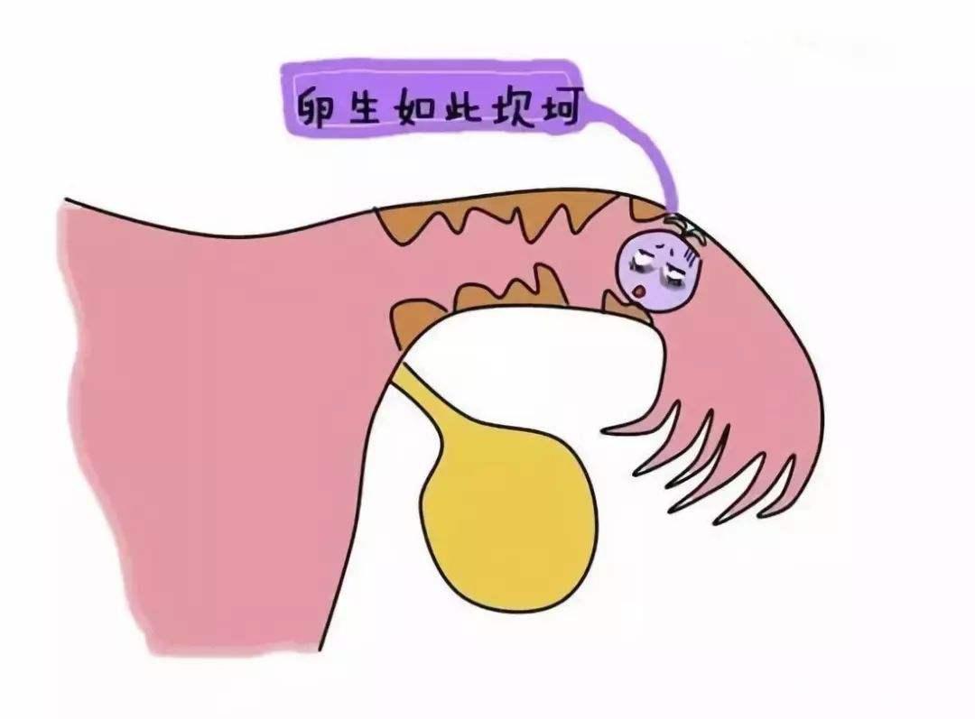 为什么切了输卵管还是会宫外孕,宫外孕为什么会切子宫