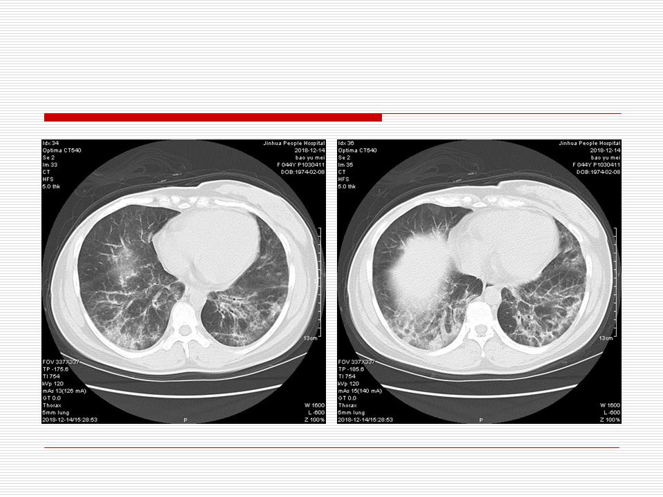 像炎症的肺癌能治好吗,医生说可能是肺癌也可能是炎症