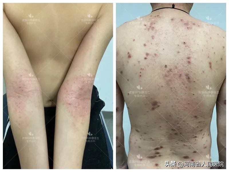 被痒吞噬的人们，是时候揭开这“湿疹”的真面目了