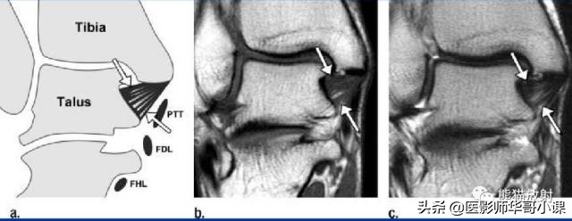 踝关节解剖视频课,解剖学韧带分布图