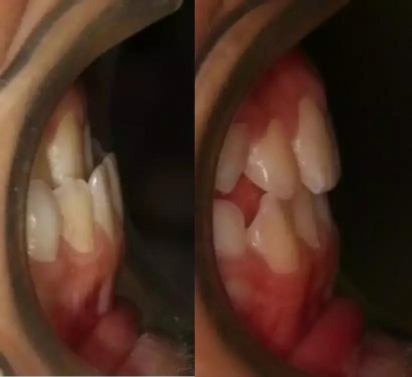 动画模拟牙齿矫正前后会变美,做了矫正牙齿会反弹吗