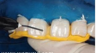 门牙缝可以补吗,为什么门牙有缝