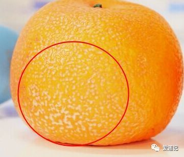 肥胖纹和皮疹的区别,肥胖纹和橘皮纹的区别