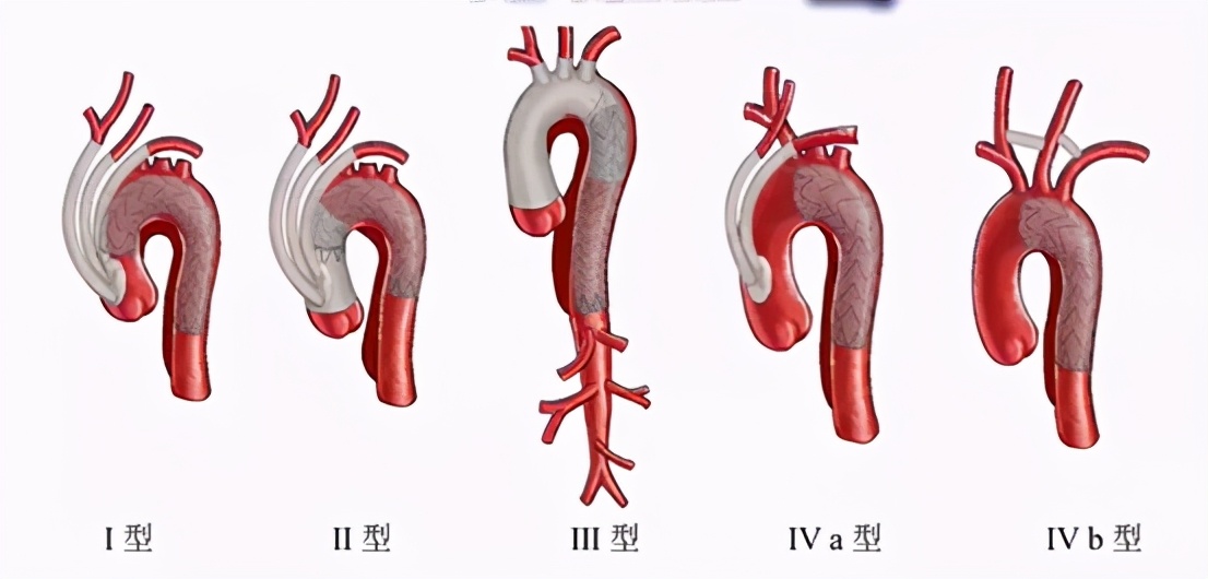 胡佳:升主动脉近端手术后新发弓部病变的腔内治疗