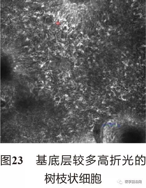 皮肤共聚焦显微镜能查什么,皮肤镜和共聚焦显微镜