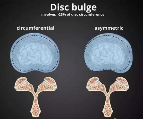 腰椎间盘的膨出和突出有什么区别,腰椎间盘膨出和突出有什么区别