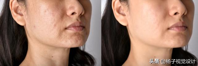 毛孔粗大油性皮肤长痘痘怎么解决,油性皮肤长痘痘毛孔粗大怎么改善