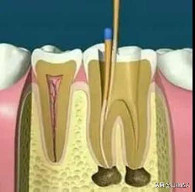 牙疼睡不着怎么缓解快速入睡,怀孕牙疼的晚上睡不着怎么缓解