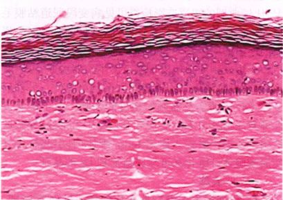男性炎症性尿道狭窄,皮肤苔藓硬化致尿道口狭窄