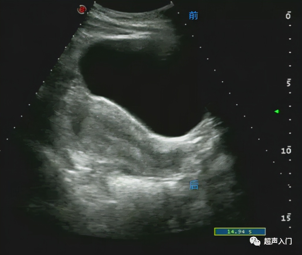 超声怎么分辨前后位子宫,超声如何区分子宫前后位