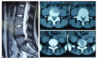腰椎间盘突出牵引更疼是怎么回事,腰椎间盘突出牵引副作用