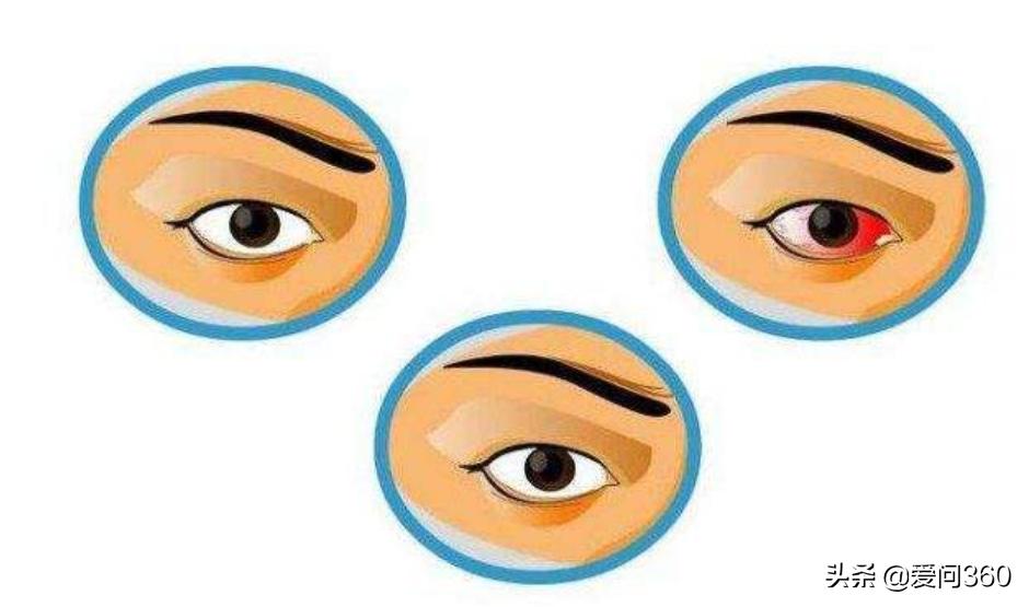 为什么会得结膜炎怎么快速治愈,过敏性结膜炎缓解痛苦的方法