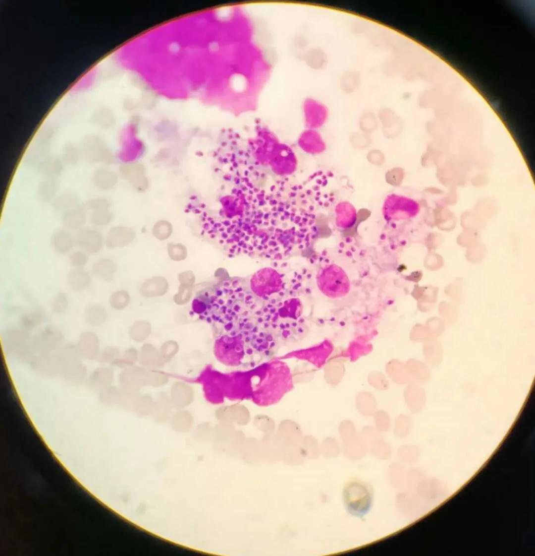 医生的恶魔,病人的死神!噬血细胞综合征来袭,生死边缘