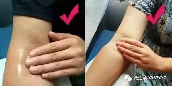 献血后手臂青紫是怎么回事,献血后针眼附近青紫怎么办