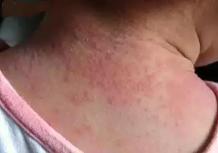 宝宝热出痱子婆婆说烂胎盘,高温天气宝宝热痱子怎么治好得快