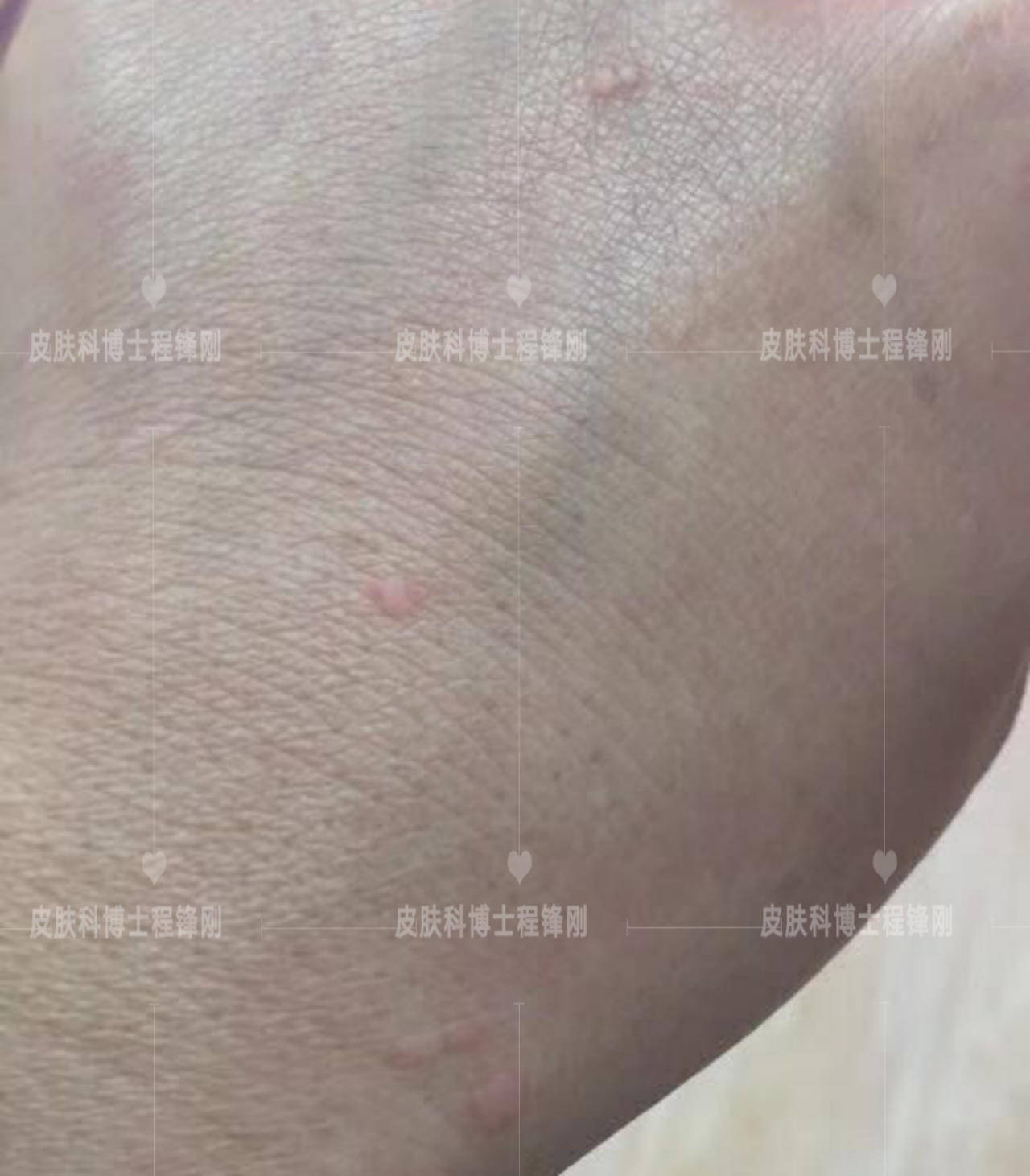 患有扁平疣要怎么根治,有扁平疣一定要及时去除吗