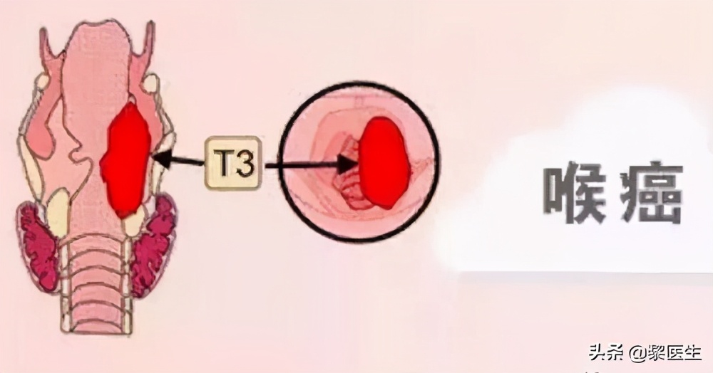 咽喉炎长期不治得了喉癌全喉切除,早期喉癌会误诊为声带息肉吗