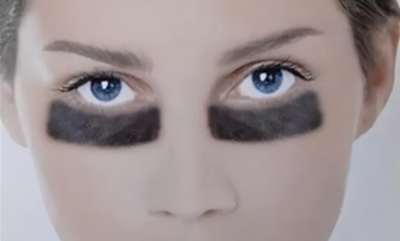 黑眼圈特别丑该怎么办,黑眼圈让人又老又难看