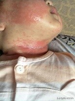 宝宝湿疹红屁股该怎么办,没出满月的宝宝湿疹还有红屁股