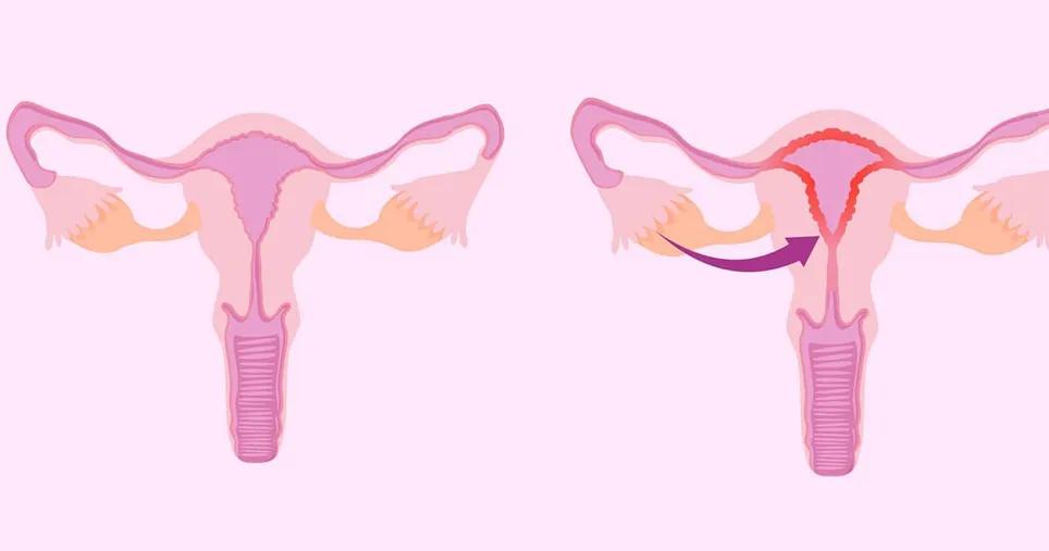 子宫内膜偏厚有什么危害吗,子宫内膜厚很危险吗