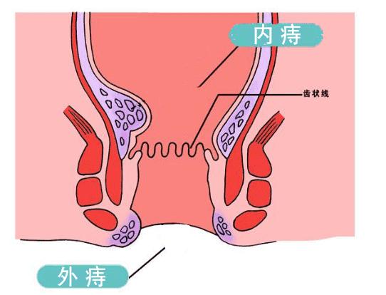 得了痔疮要手术？还能吃辣？会不会发展成肛裂、脱肛？答案都在这
