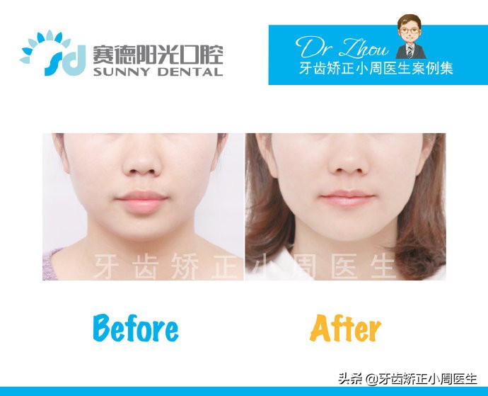 下巴后缩整容玻尿酸还是假体,如何不靠整容改变下巴