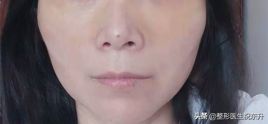 做眼袋提眉法令纹深了,上眼皮的皱纹提眉可以解决吗